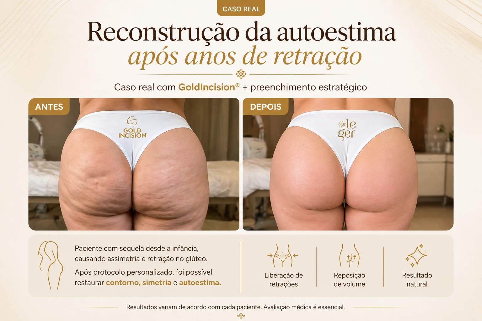 Caso real: Reconstrução da autoestima após anos de retração - Antes e Depois com GoldIncision e preenchimento estratégico
